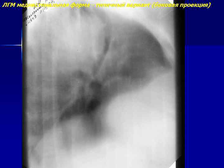ЛГМ медиастинальная форма - типичный вариант (боковая проекция) 