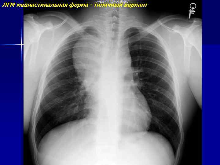 ЛГМ медиастинальная форма - типичный вариант 