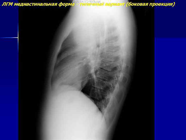 ЛГМ медиастинальная форма - типичный вариант (боковая проекция) 