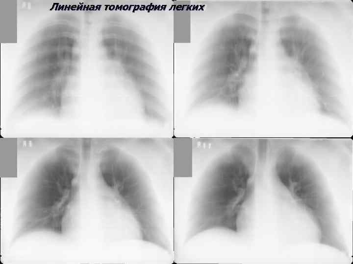 Линейная томография легких 