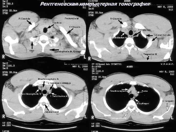 Рентгеновская компьютерная томография 