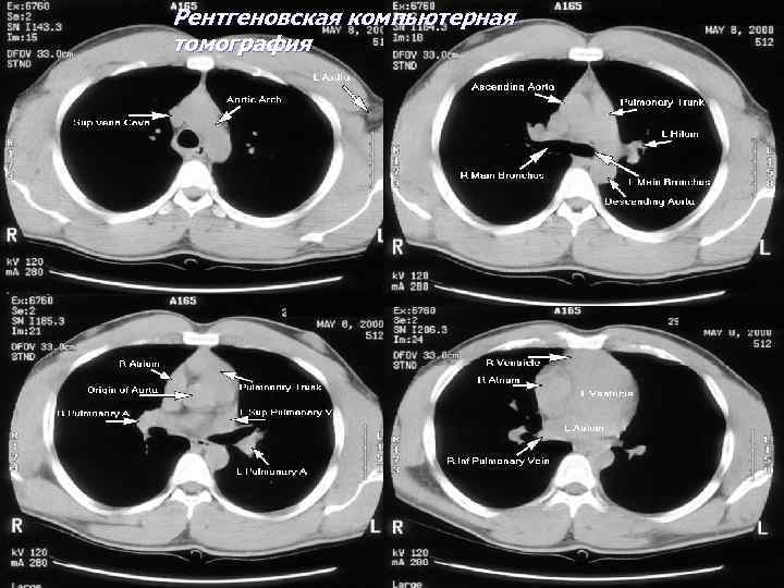 Рентгеновская компьютерная томография 