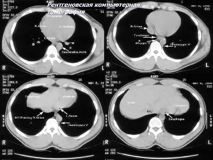 Рентгеновская компьютерная томография 