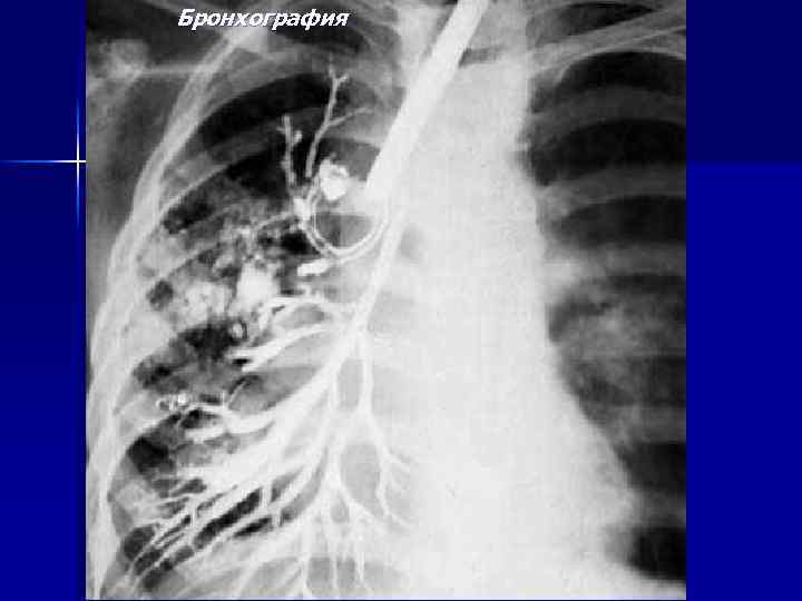 Бронхография 