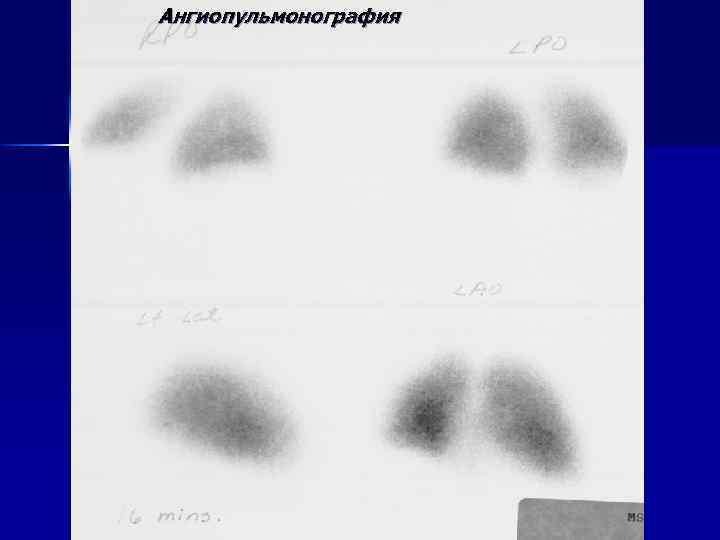 Ангиопульмонография 