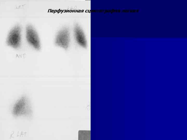 Перфузионная сцинтиграфия легких 