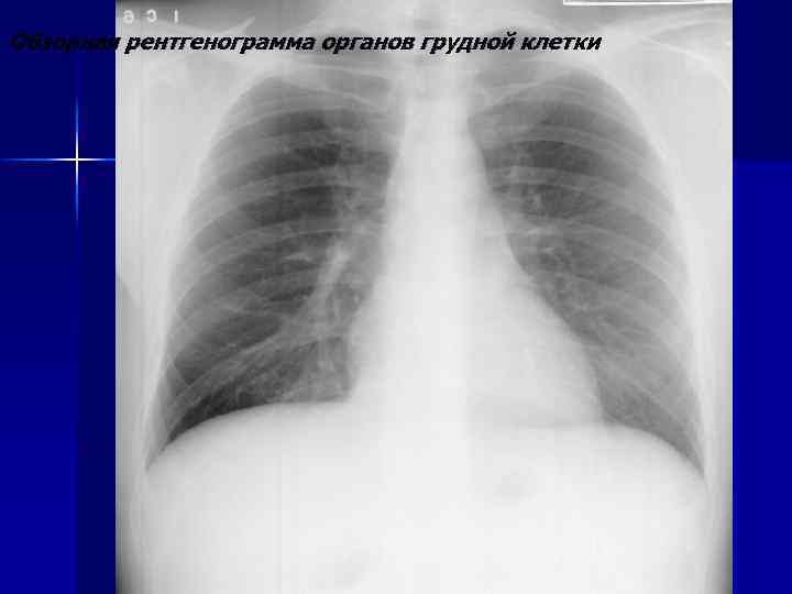 Обзорная рентгенограмма органов грудной клетки 