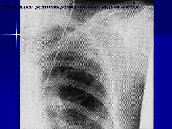 Прицельная рентгенограмма органов грудной клетки 