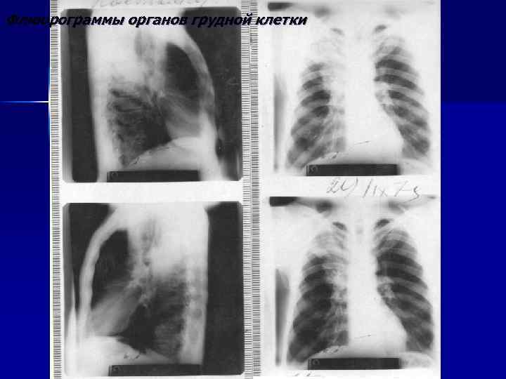 Флюорограммы органов грудной клетки 