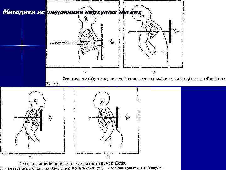 Методики исследования верхушек легких 