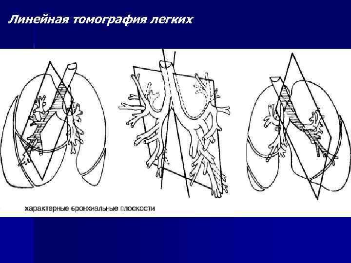 Линейная томография легких 