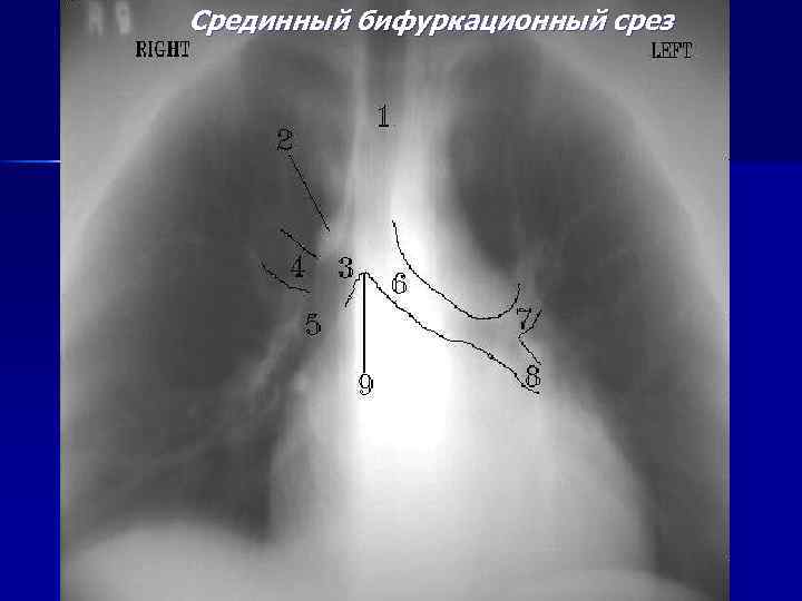 Срединный бифуркационный срез 
