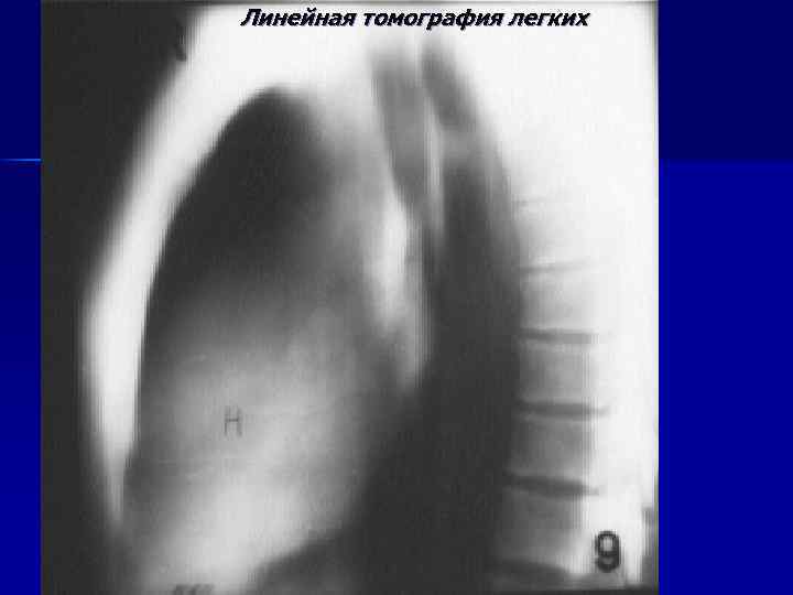 Линейная томография легких 