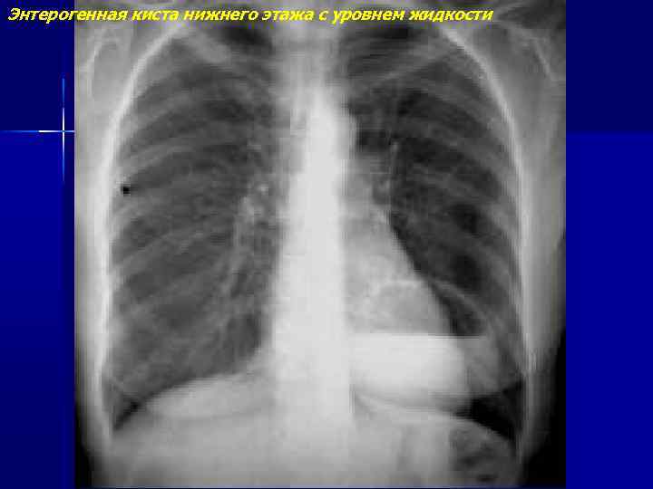 Энтерогенная киста нижнего этажа с уровнем жидкости 