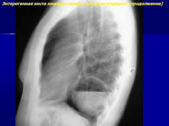 Энтерогенная киста нижнего этажа с уровнем жидкости (продолжение) 