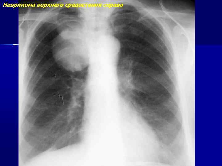 Невринома верхнего средостения справа 