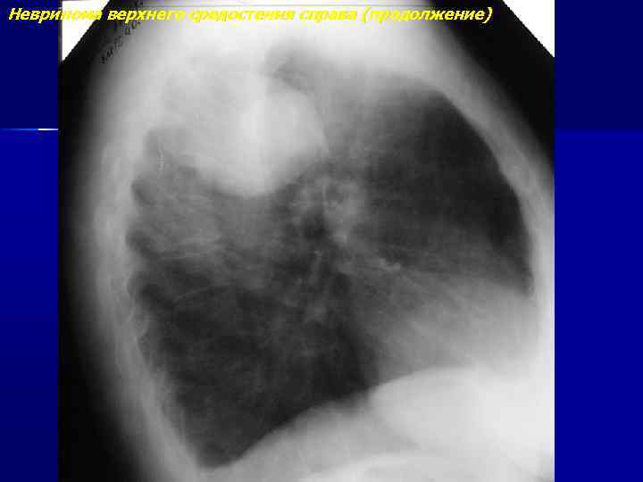 Невринома верхнего средостения справа (продолжение) 