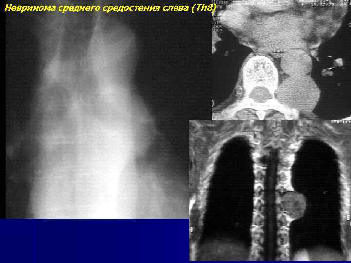 Невринома среднего средостения слева (Тh 8) 