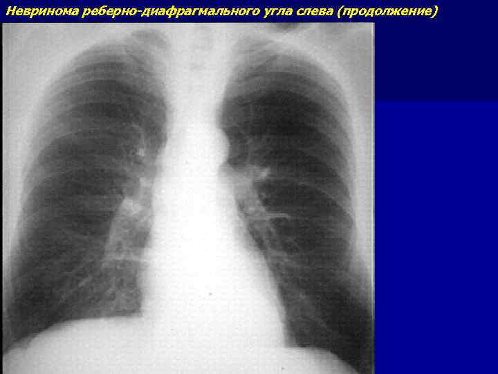 Невринома реберно-диафрагмального угла слева (продолжение) 