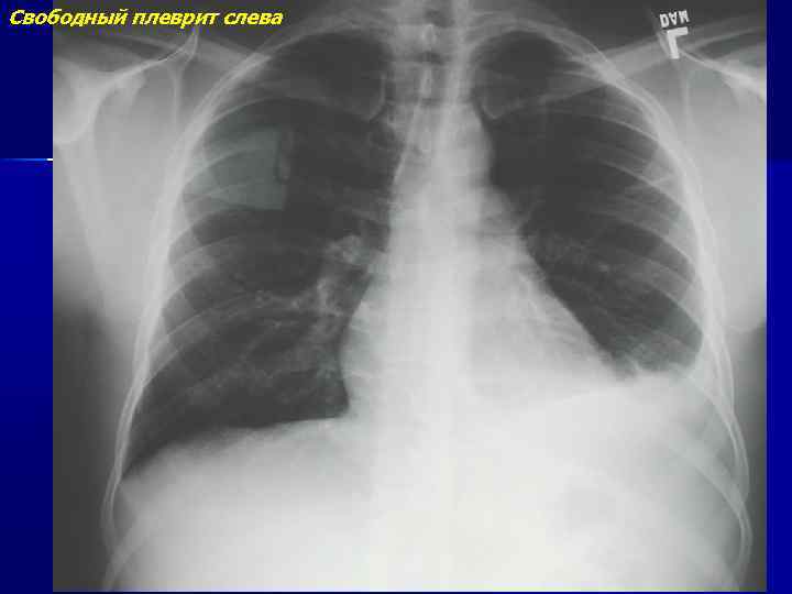 Рентгенологическая картина при экссудативном плеврите