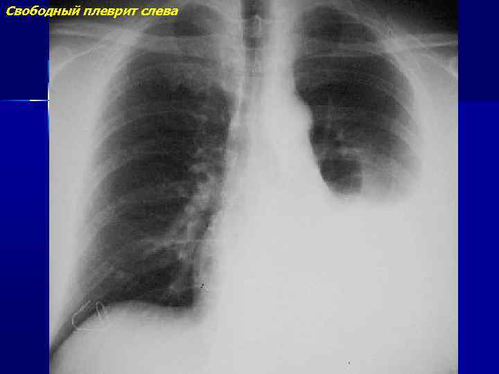Свободный плеврит слева 