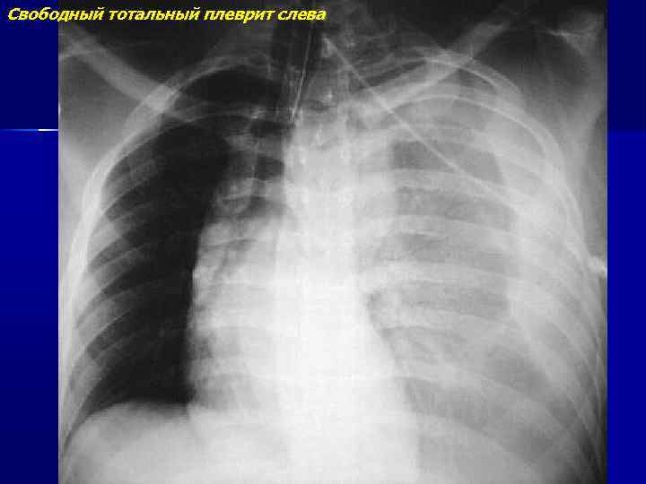 Свободный тотальный плеврит слева 