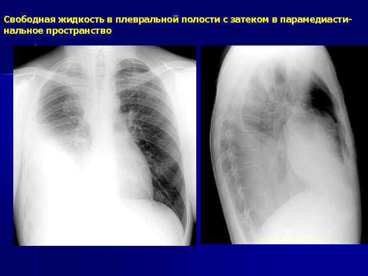 Почему на рентгеновском снимке изображение газа в плевральной полости черное