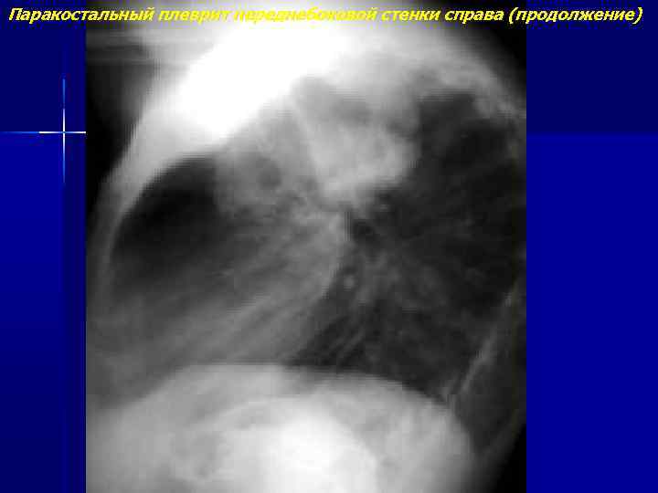 Паракостальный плеврит переднебоковой стенки справа (продолжение) 