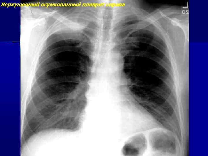 Верхушечный осумкованный плеврит справа 