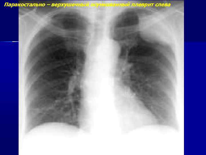 Паракостально – верхушечный осумкованный плеврит слева 
