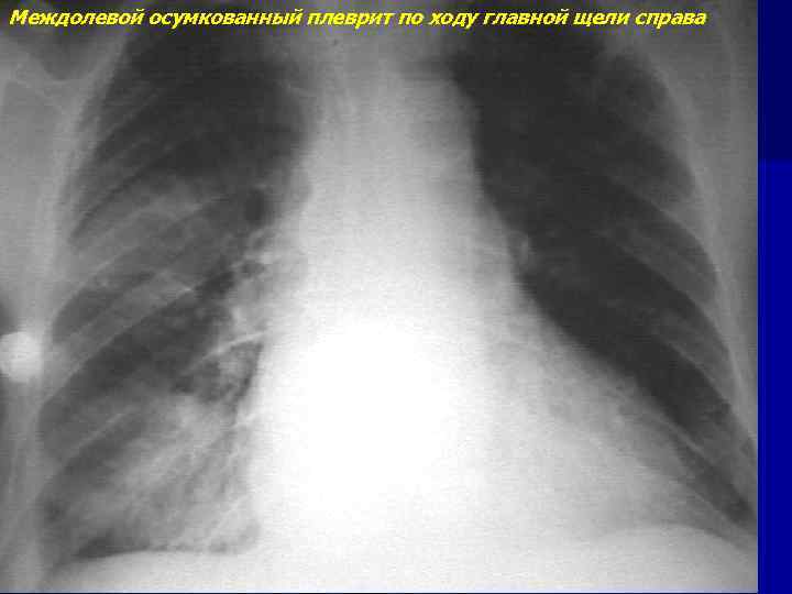 Гидроторакс слева. Осумкованный плеврит рентген. Осумкованный междолевой плеврит.