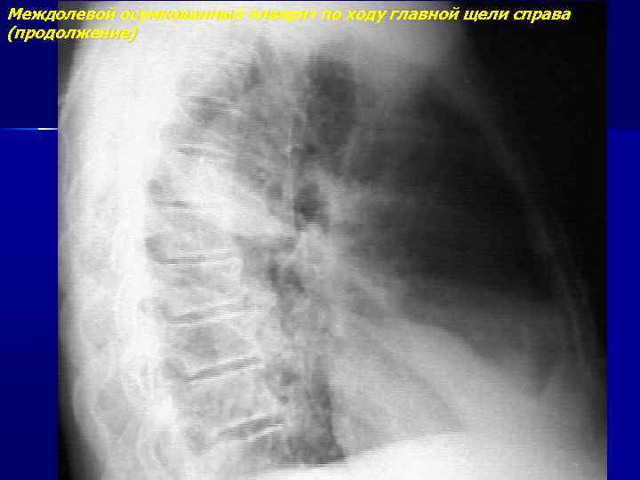 Междолевой осумкованный плеврит по ходу главной щели справа (продолжение) 