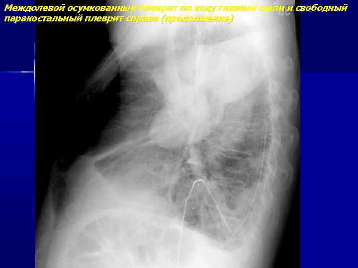 Гидроторакс на кт. Осумкованный паракостальный плеврит. Осумкованный гидроторакс рентген. Осумкованный плеврит рентген.