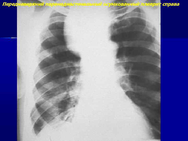 Передневерхний парамедиастинальный осумкованный плеврит справа 