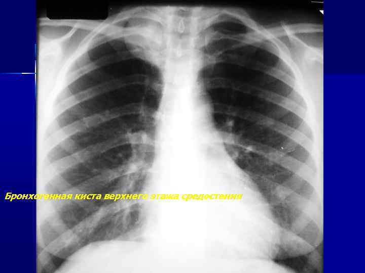 Бронхогенная киста верхнего этажа средостения 