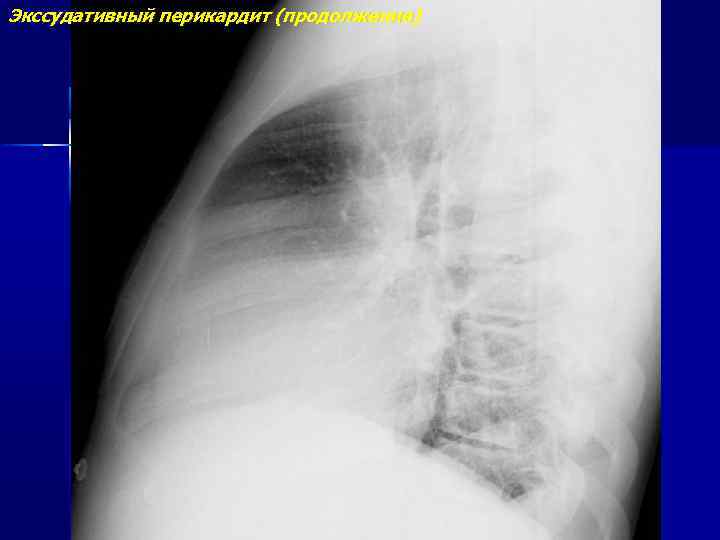 Экссудативный перикардит (продолжение) 