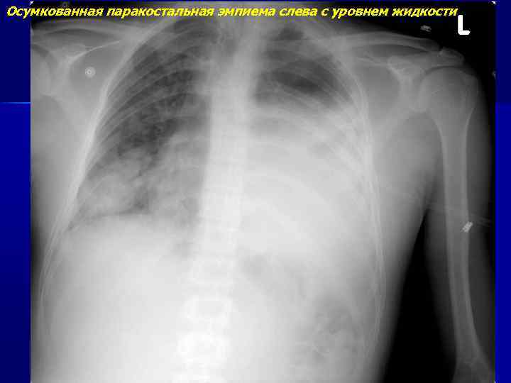 Гидроторакс слева. Осумкованный гидроторакс рентген. Осумкованный плеврит рентген. Осумкованный гидроторакс кт.