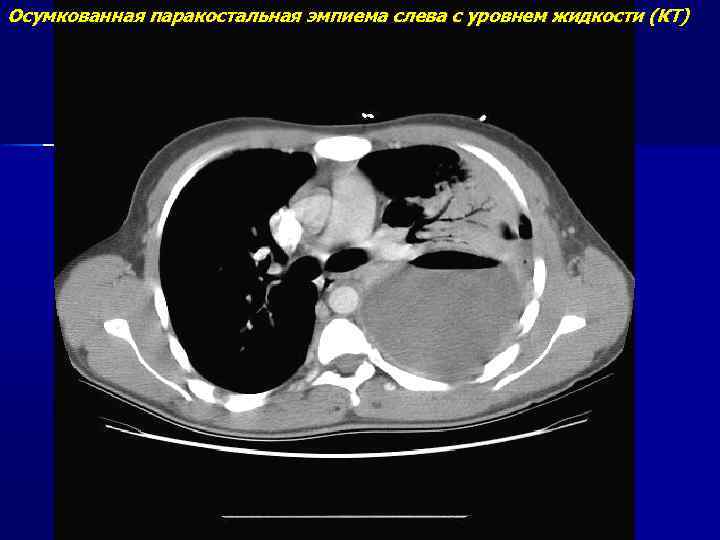 Гидроторакс на кт. Осумкованный плеврит кт картина. Осумкованный плеврит на кт. Осумкованная эмпиема плевры на кт.