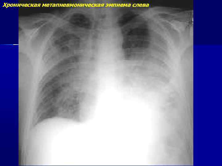 Хроническая метапневмоническая эмпиема слева 