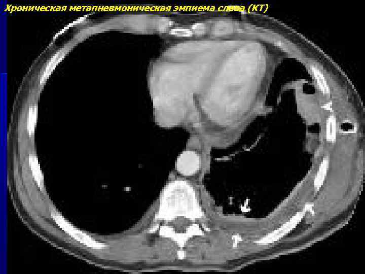 Хроническая метапневмоническая эмпиема слева (КТ) 