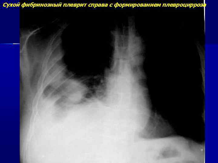 Сухой фибринозный плеврит справа с формированием плевроцирроза 