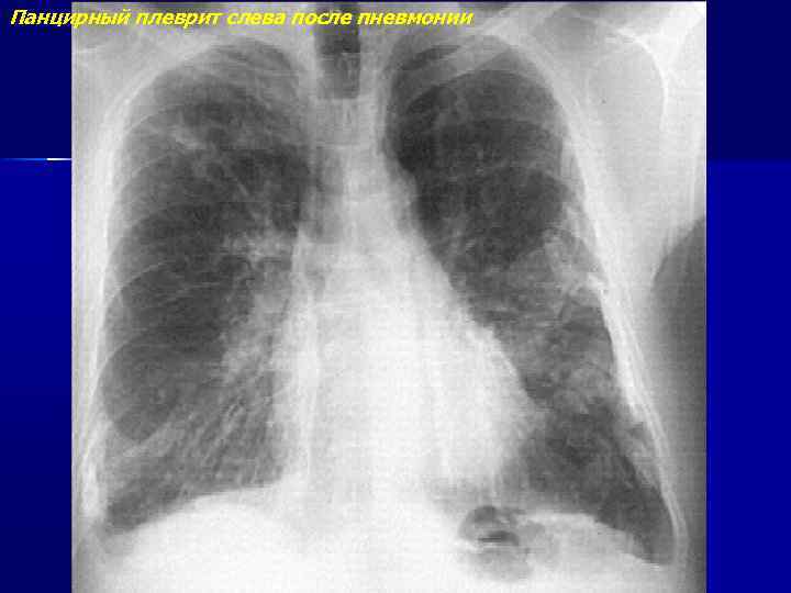 Панцирный плеврит слева после пневмонии 