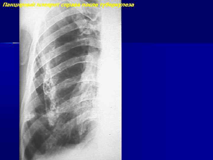 Панцирный плеврит справа после туберкулеза 
