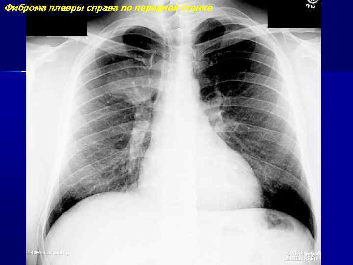 Фиброма плевры справа по передней стенке 