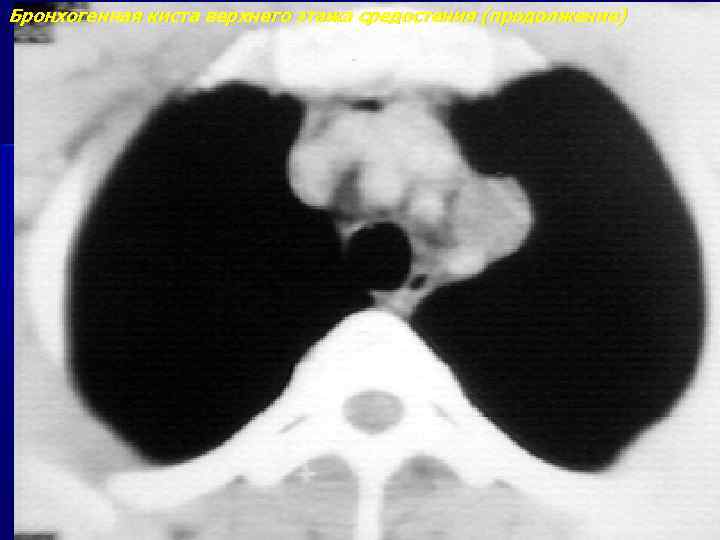 Бронхогенная киста верхнего этажа средостения (продолжение) 
