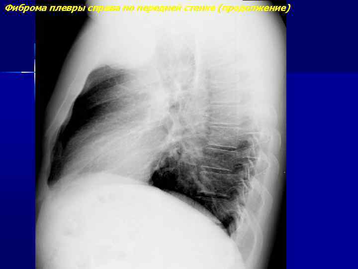 Фиброма плевры справа по передней стенке (продолжение) 