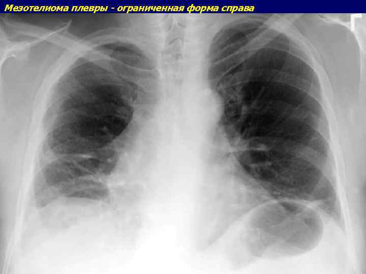 Мезотелиома плевры - ограниченная форма справа 