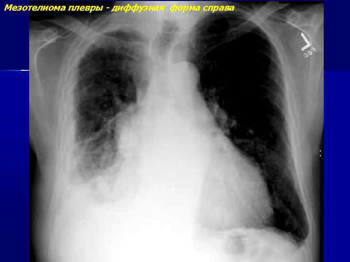 Инкрустация плевры рентгенологическая картина