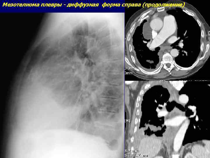 Мезотелиома плевры кт картина