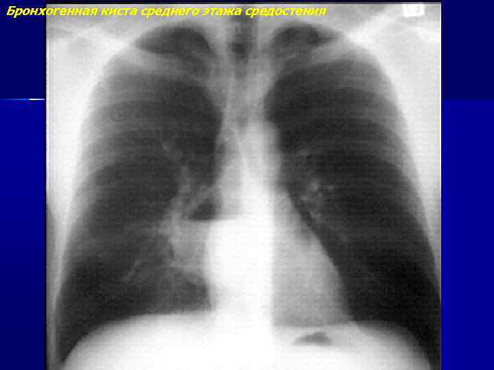 Бронхогенная киста среднего этажа средостения 